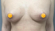 Подтяжка груди: фото 12 после